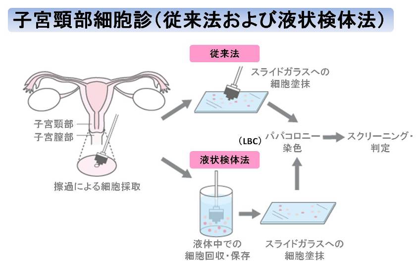 子宮頸部細胞診